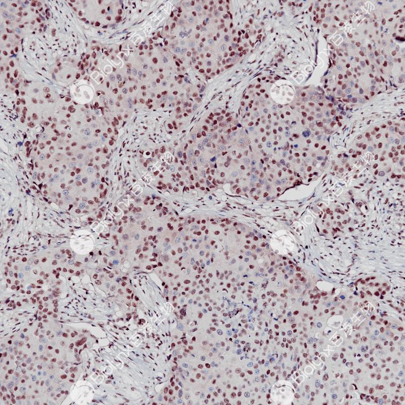 乳腺癌E2F4（BP6256）染色