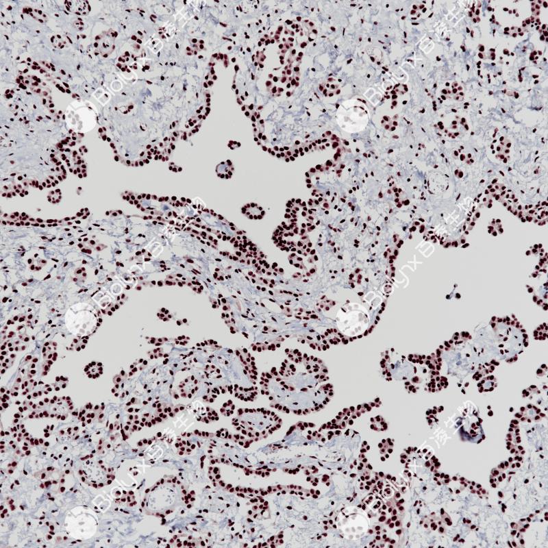 间皮瘤BAP-1（BP6255）染色