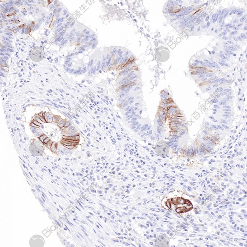 结肠癌L1CAM（BP6257）染色