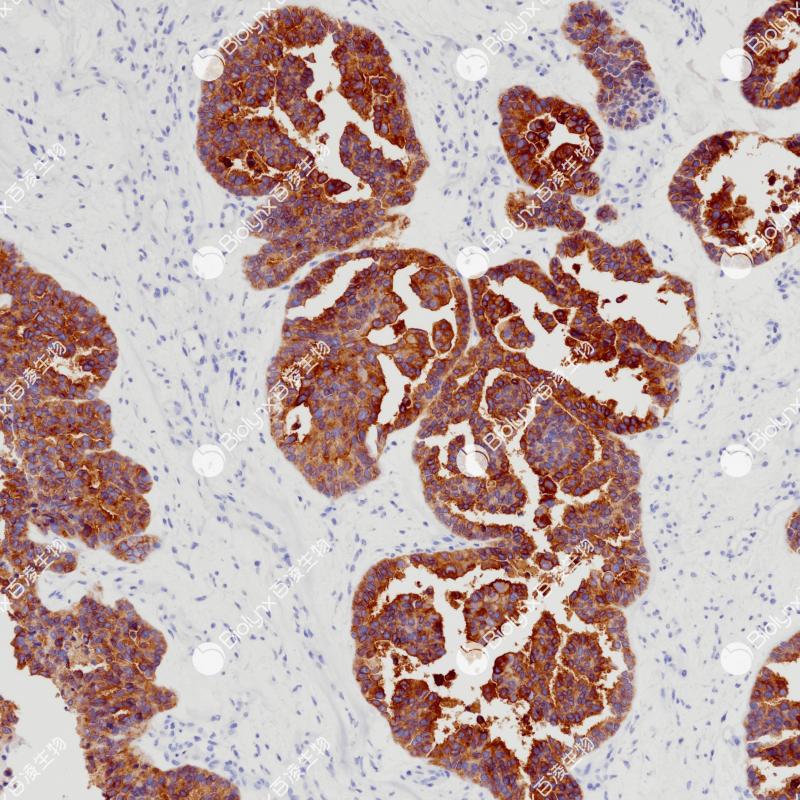 卵巢癌Claudin 6（BP6274）染色