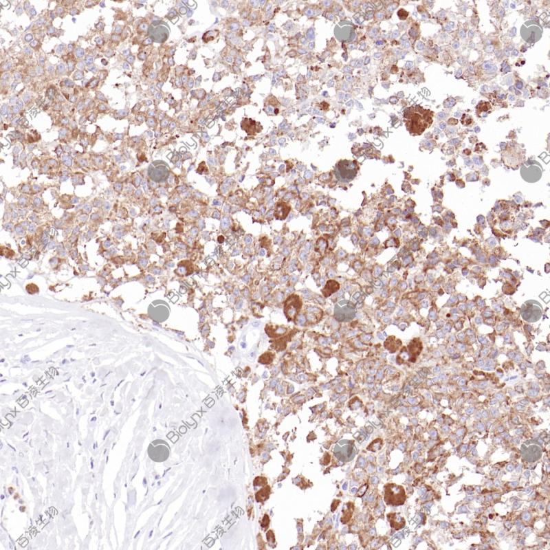 恶性黑色素瘤CD63（BP6271）染色