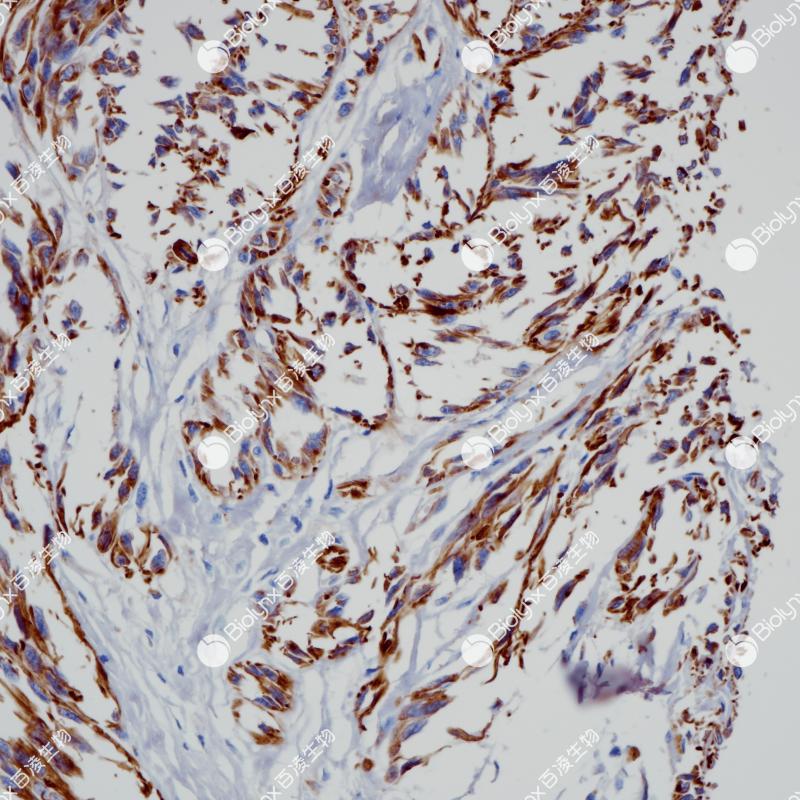 恶性黑色素瘤Nestin（BP6275）染色