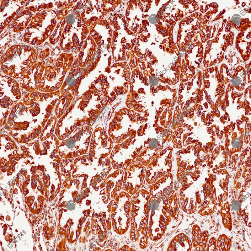 肺腺癌Calreticulin（BP6279）染色