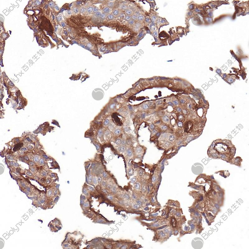前列腺癌PSMA（BP6276）染色