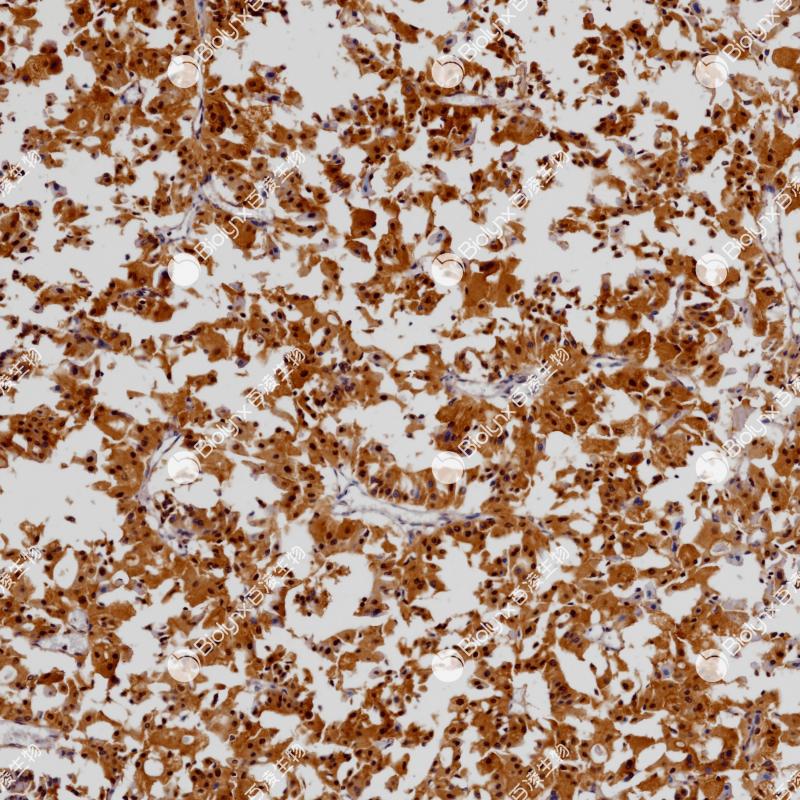 肾嫌色细胞癌Parvalbumin alpha（BP6278）染色
