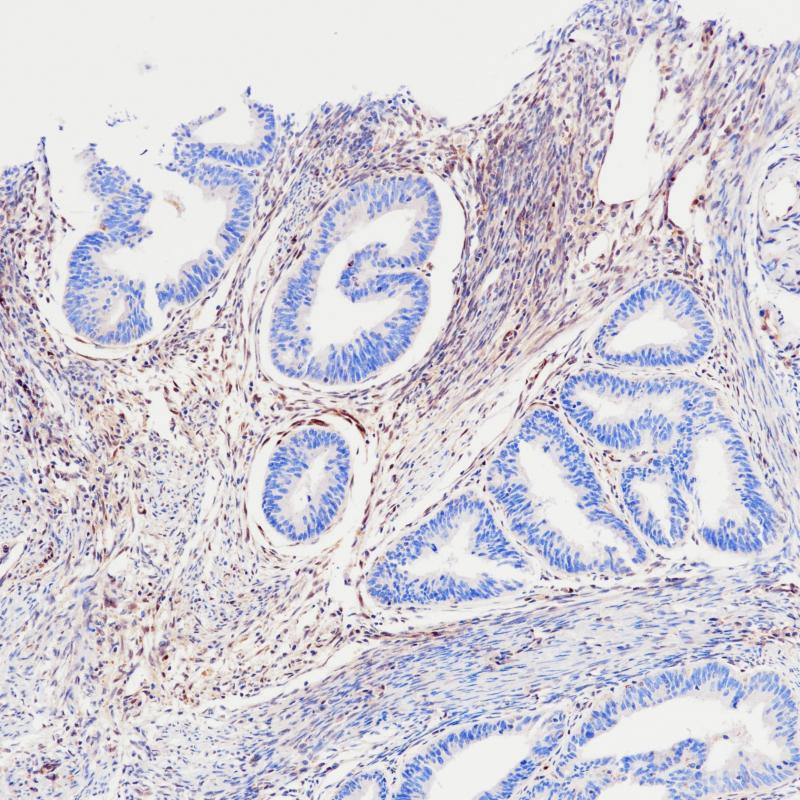 ​子宫内膜癌PTEN(BP6283)染色