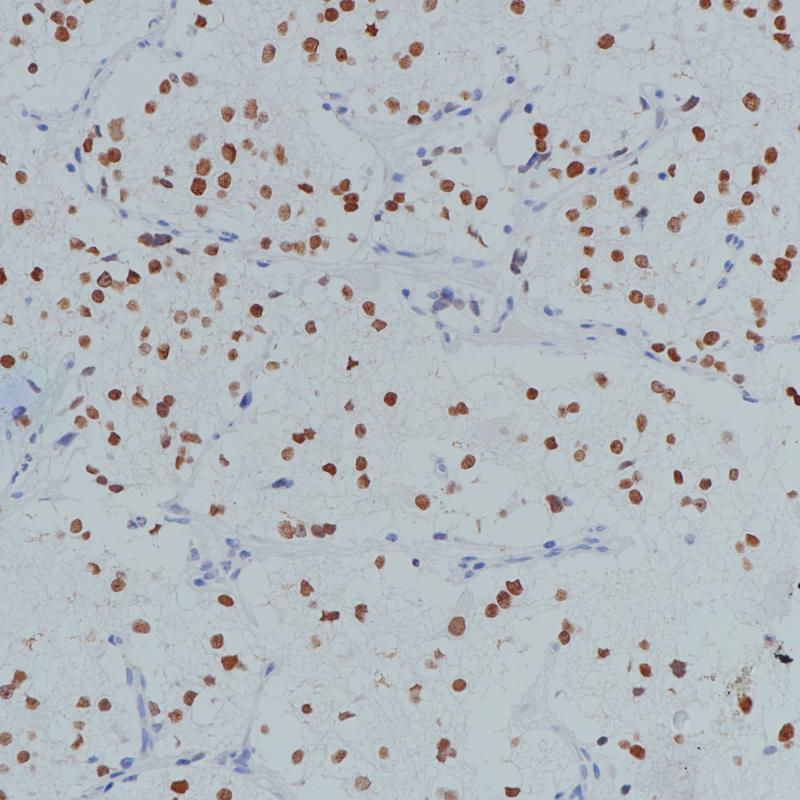 神经母细胞瘤PHOX2B（BP6154）染色