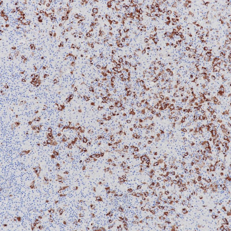 霍奇金淋巴瘤CD15M（MMA）染色
