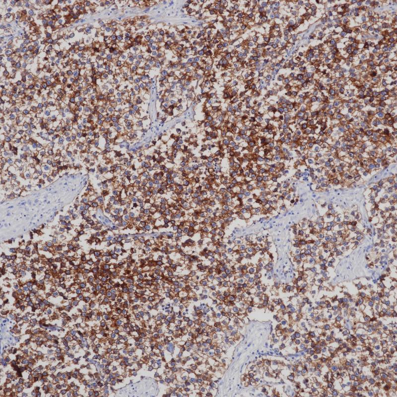 精原细胞瘤PLAP（BPM6151）染色