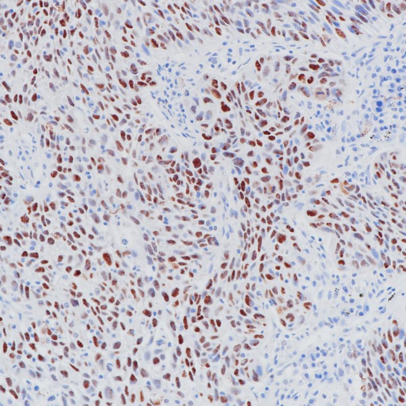 肺鳞癌p53（BPM6168）染色