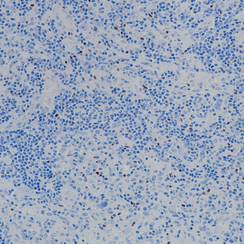 霍奇金淋巴瘤FOXP3（BP6166）染色