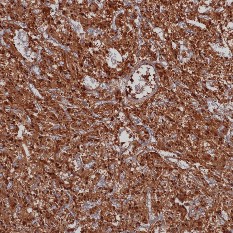 嗜铬细胞瘤NSE（BPM6150）染色