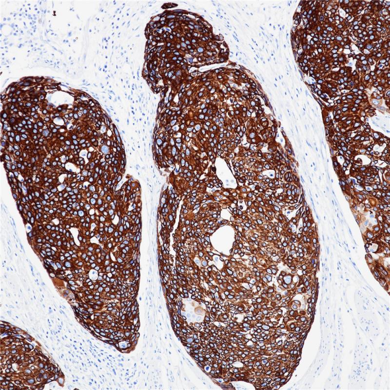食管鳞癌 ck14 (bp6052) 染色